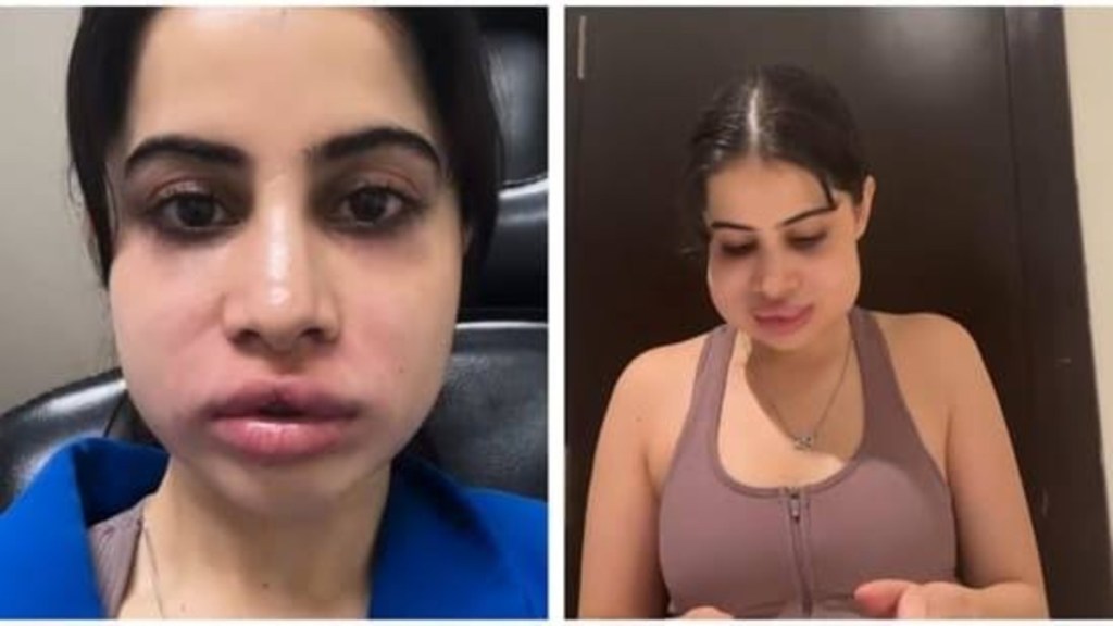 Uorfi Javed Makes Fun of Her Swollen Face In The Video Shared By Her On The Internet, Her Sister Asks, ‘Can You Say Anything?’